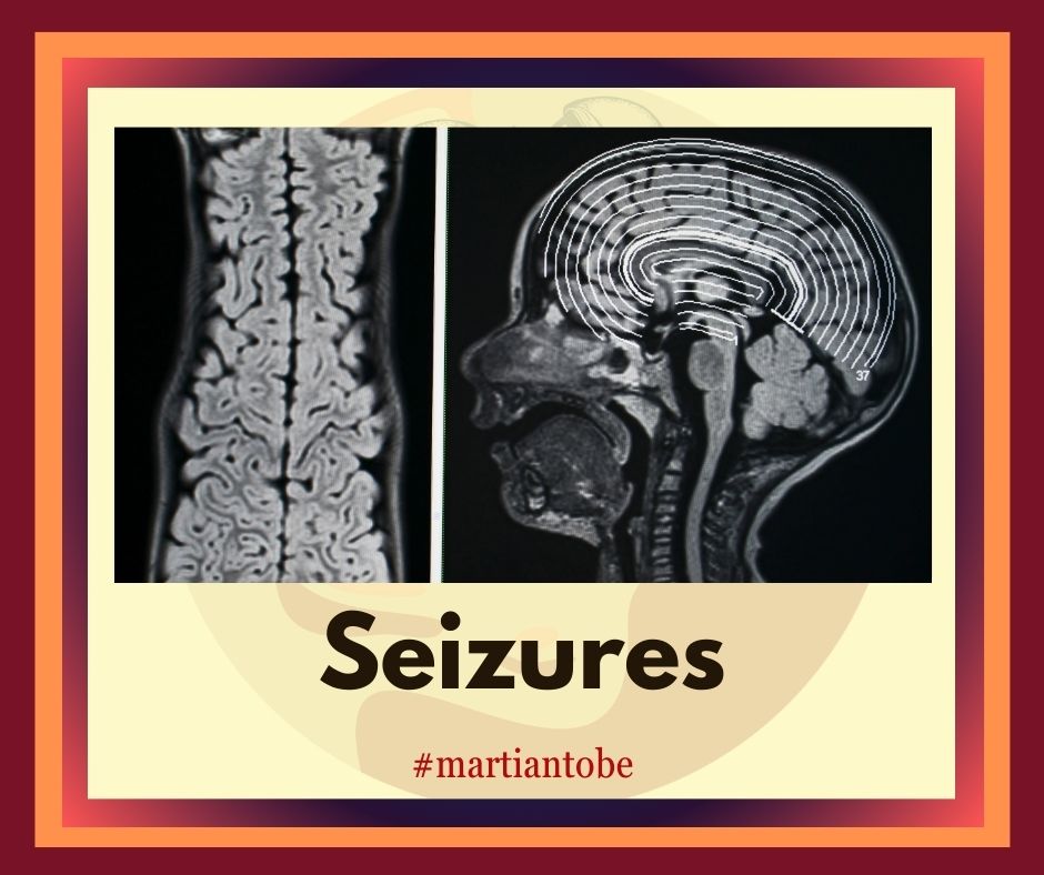 Seizures